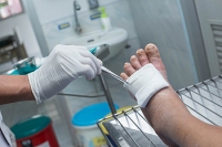 Treatment for Foot Ulcers Caused by Diabetes