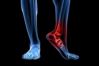 Foot Bone Fractures May Be Warning Signs
